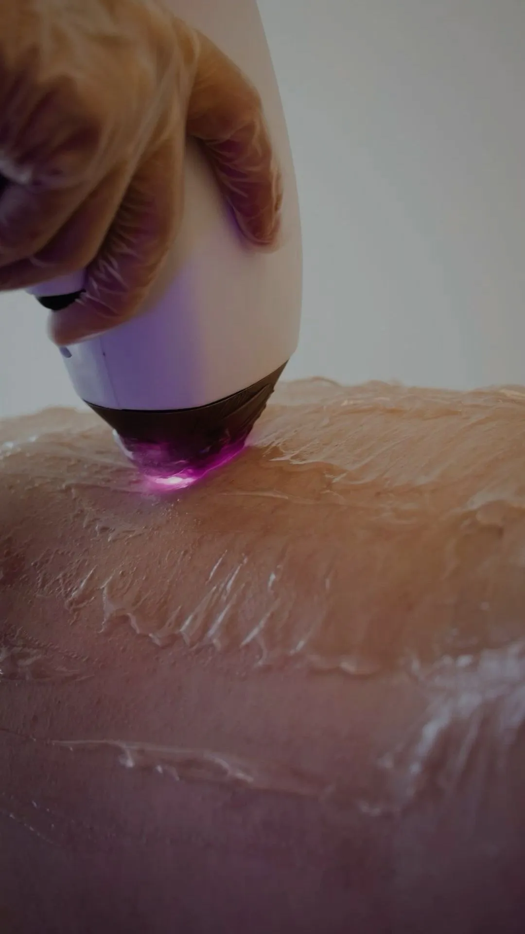 Epilare Definitivă cu Laser Elysia Beauty Lounge București
